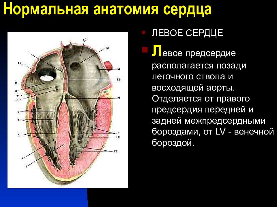 Левое сердце. Нормальная анатомия сердца. Сердце обезьяны анатомия. Межпредсердная борозда. Межпредсердная борозда сердца.