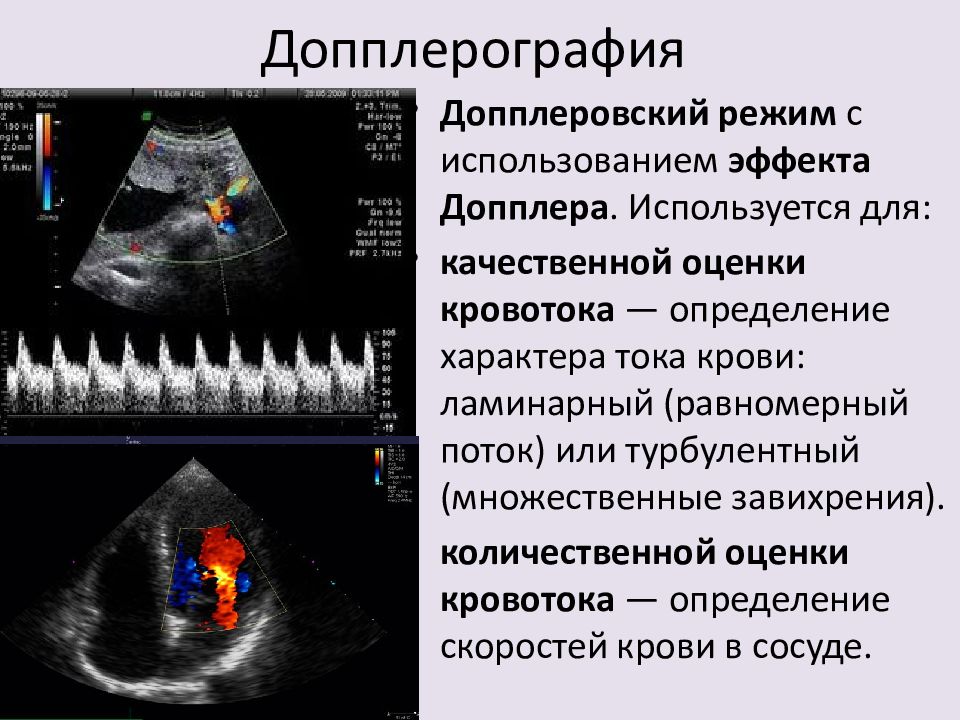 Что такое уздг. УЗИ импульсный допплеровский режим. Ультразвуковая допплерография прямой синус. Измерения эхокардиография доплером. Ультразвуковая высокочастотная допплерография.