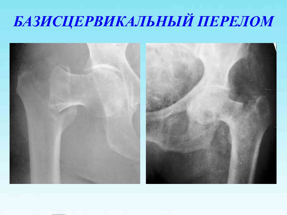 Трещина шейки. Субкапитальный перелом шейки бедра рентген. Субкапитальный перелом бедренной кости. Субкапитальный перелом бедра. Базисцервикальный перелом шейки бедра.