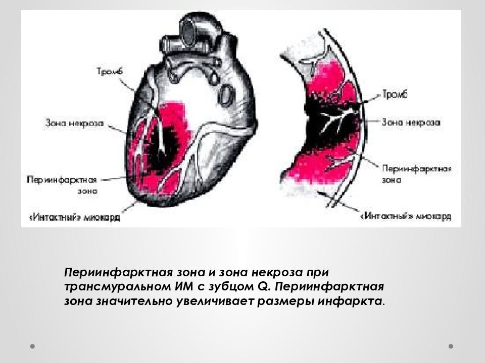 Острый инфаркт миокарда картинки