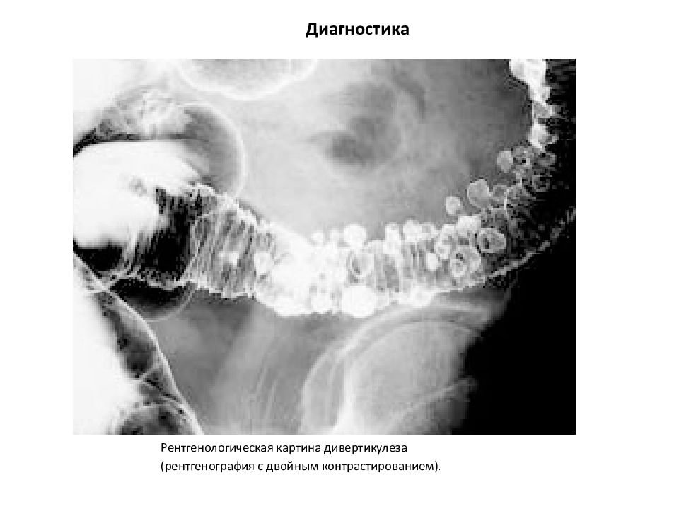 Дивертикул кишечника картинки