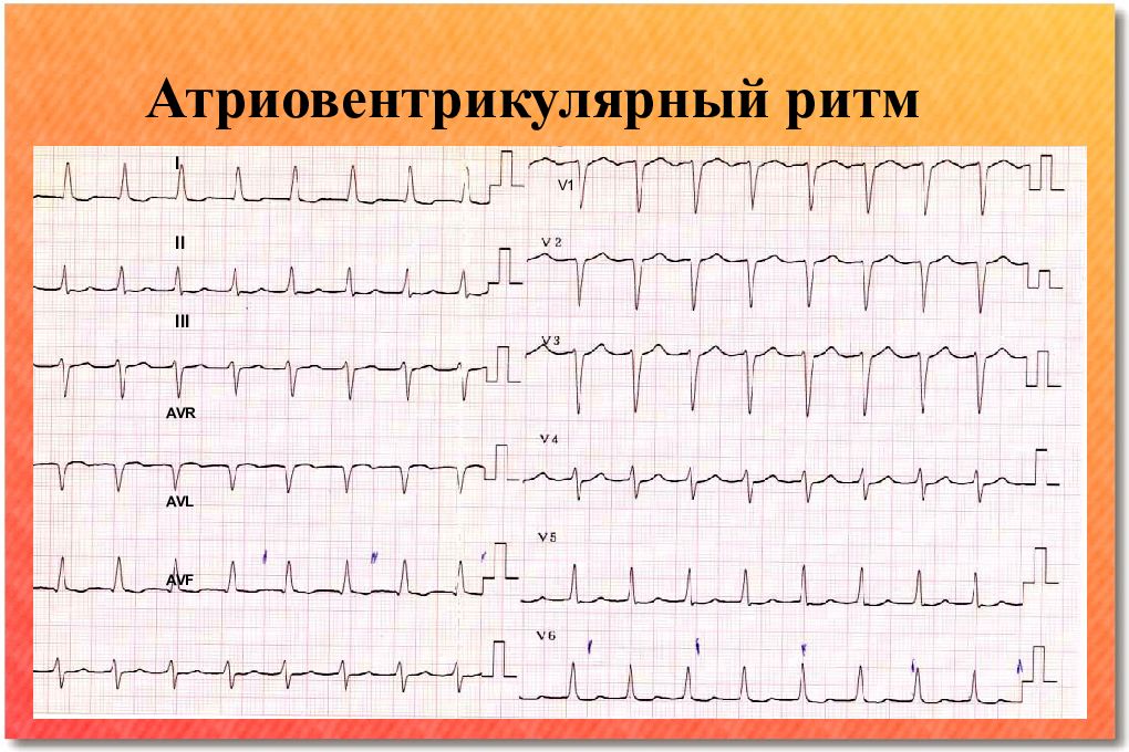 Экг при нарушениях ритма и проводимости презентация