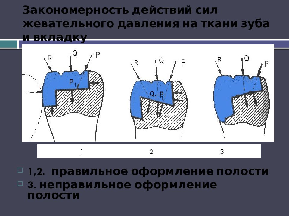 Закономерность действий сил жевательного давления на ткани зуба и вкладку