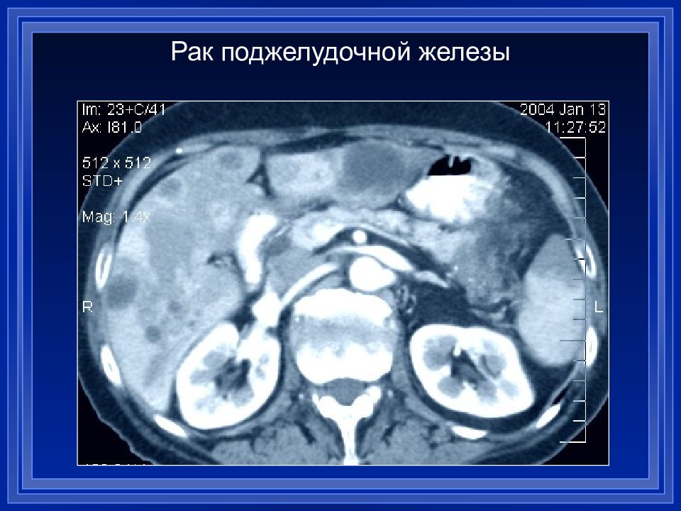 Есть при раке поджелудочной железы. Объемное образование головки поджелудочной железы кт. Опухоль крючковидного отростка поджелудочной железы кт. Опухоль хвоста поджелудочной железы кт. Опухоль поджелудочной железы злокачественная диагностика.