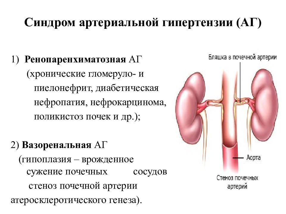 Гипоплазия почки. Синдром гипертензии артериальной гипертензии. Гипоплазия почечной артерии. При синдроме артериальной гипертензии гипертрофируется. Синдром вртериальной гипотензии.