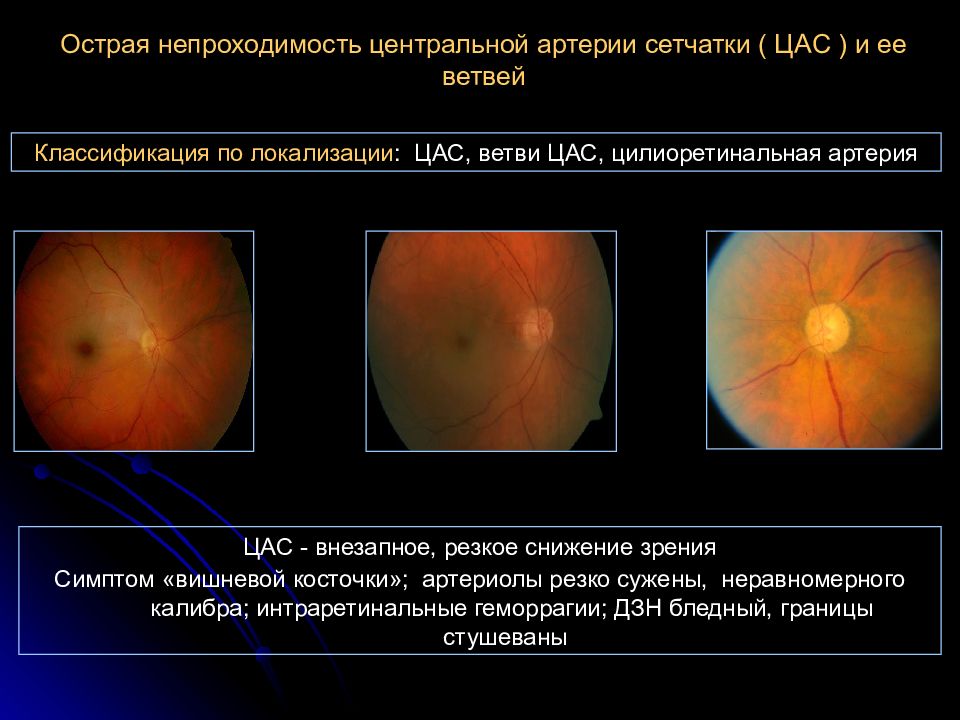 Центральная окклюзия сетчатки. Острая непроходимость центральной артерии сетчатки (цас).. Симптомы острой непроходимости центральной артерии сетчатки. Проявления острой непроходимости центральной артерии сетчатки. Острая непроходимость центральной артерии сетчатки и ее ветвей.