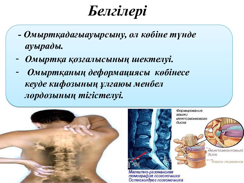 Остеохондроз презентация неврология