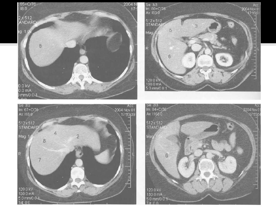 Сегменты печени на кт схема