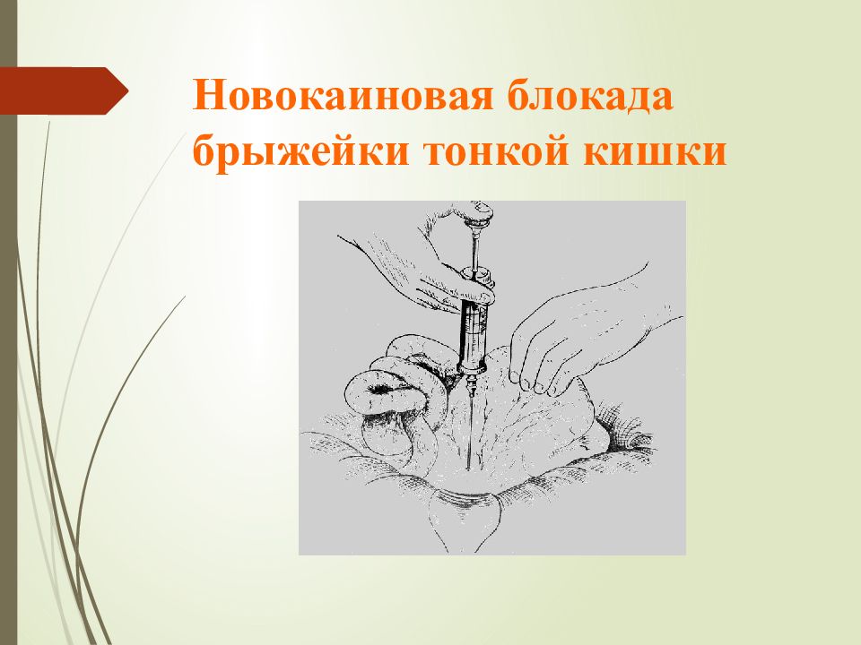 Блокада новокаином. Новокаиновая блокада корня брыжейки. Новокаиновые блокады в хирургии. Новокаиновая блокада кишечника. Блокада корня брыжейки тонкой кишки.