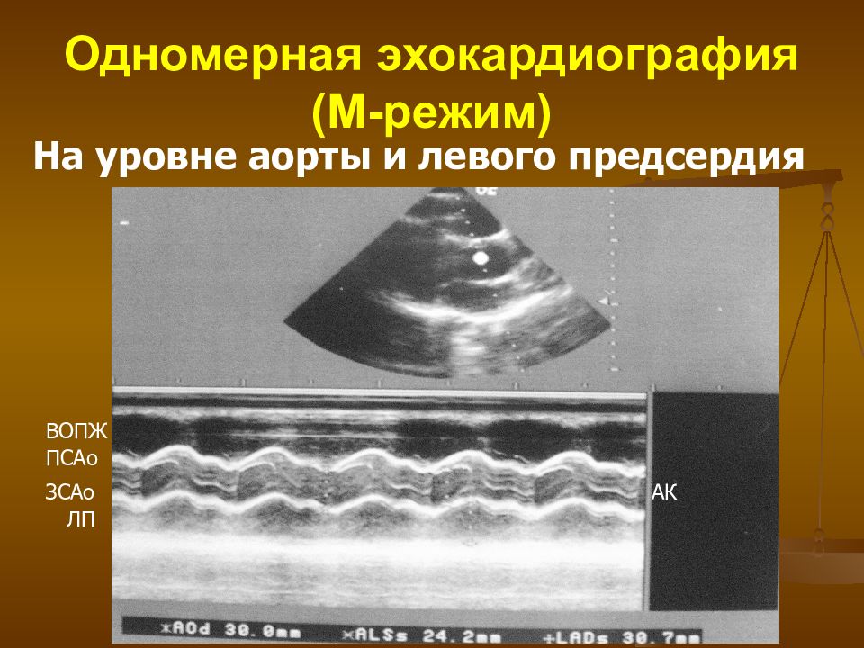 Сделай эхо. Одномерная ЭХОКГ. Одномерная эхокардиография. Эхокардиография м режим. Двухмерная эхокардиография.