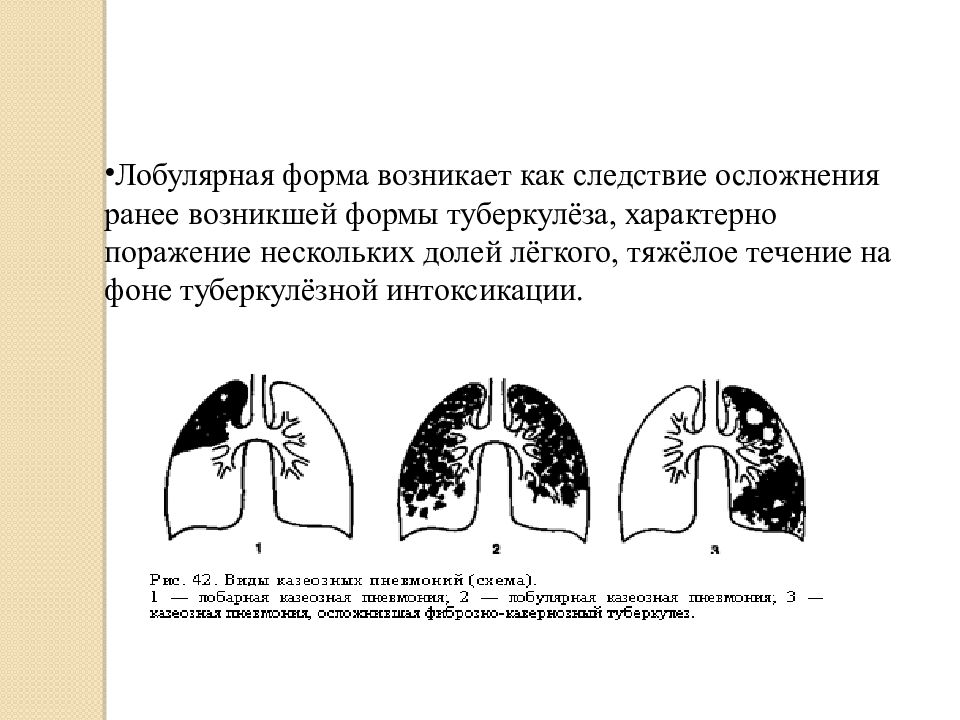 Казеозная пневмония схема