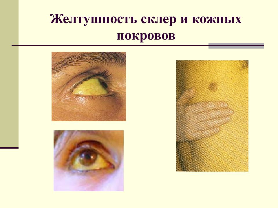 Гепатит а это желтуха. Желтушность кожи и склер. Желтушность кожи и склер при гепатите. Гепатит а желтуха кожных покровов. Желтушность кожи гепатит с.