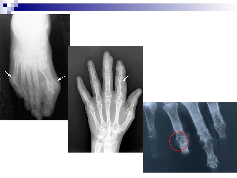 Рентген картина при подагре