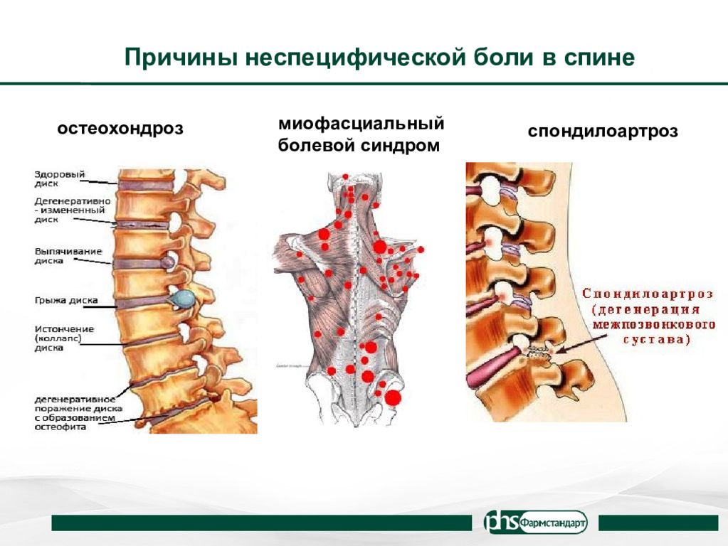 Неспецифическая боль в спине. Остеохондроз спондилоартроз. Неспецифические скелетно-мышечные боли в спине. Причины неспецифической боли в спине.