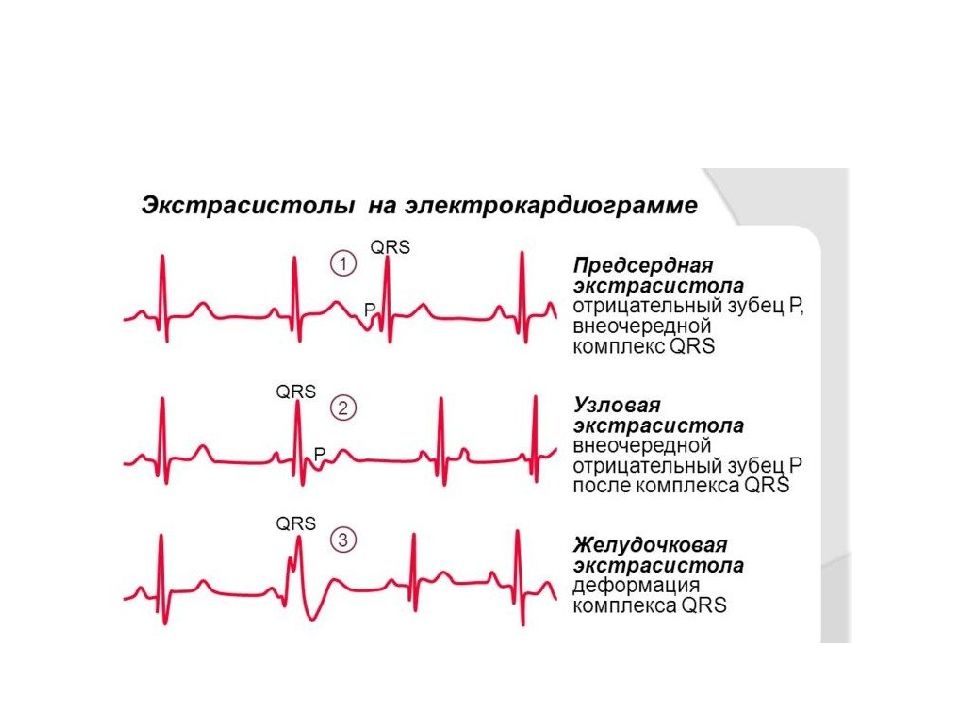 Экстрасистолия лечение