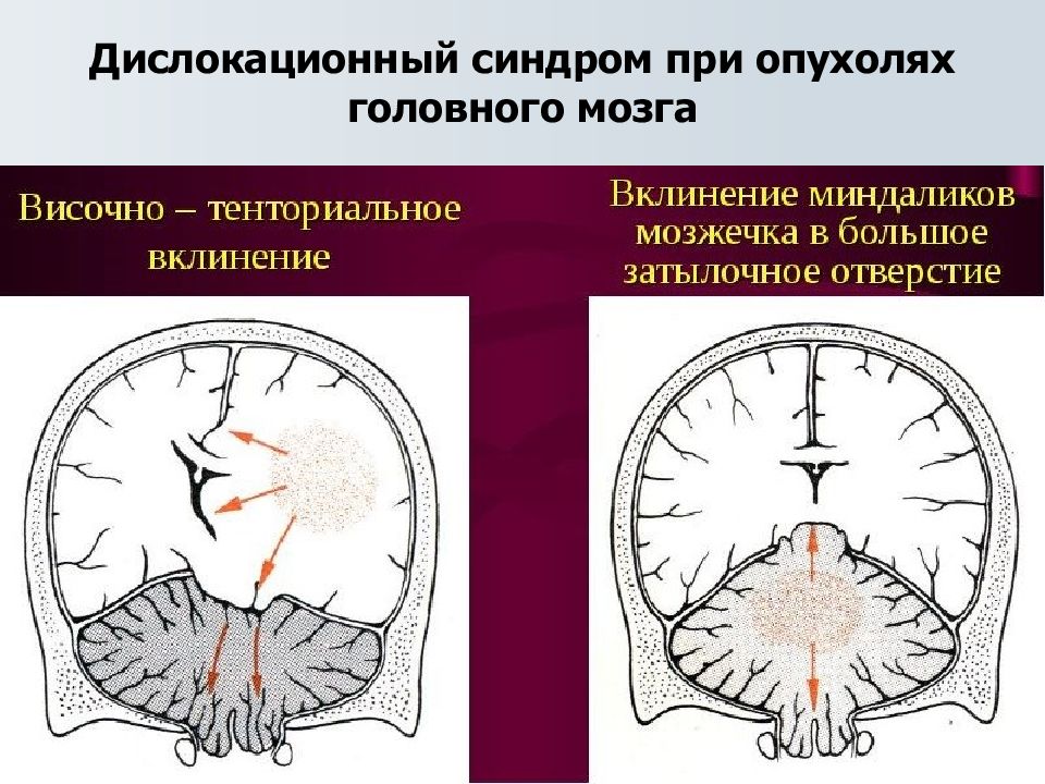 Синдром головного мозга