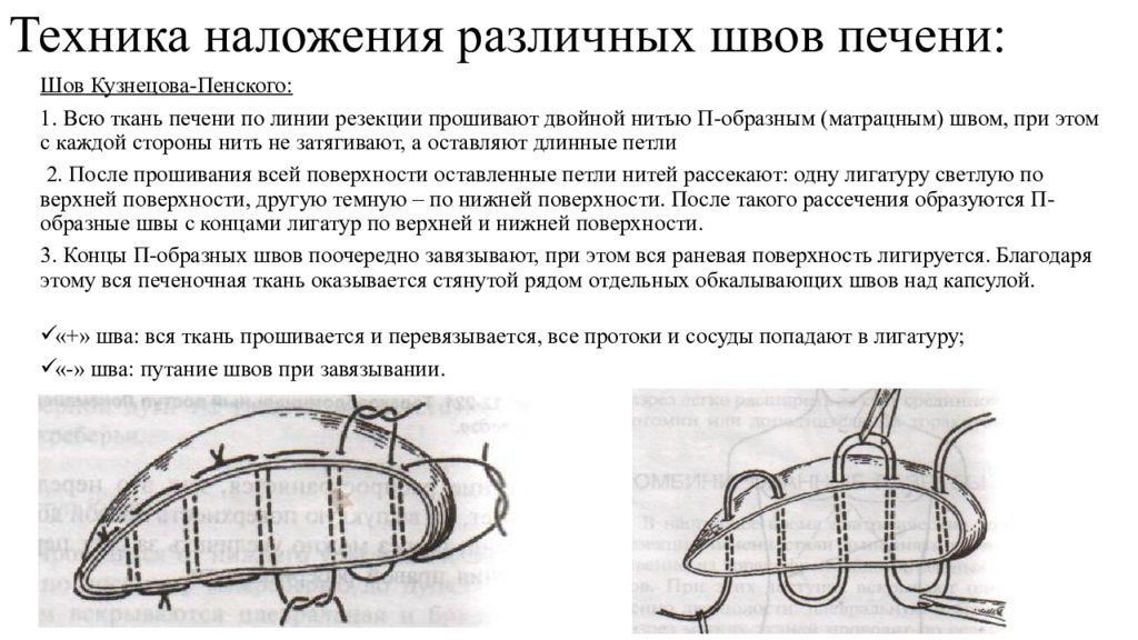 Наложение шва латынь. Матрацный шов печени. П образный шов техника наложения. Шов Кузнецова Пенского. Шов печени по Кузнецову-пенскому.