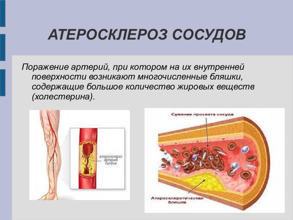 Заболевание атеросклероз. Атеросклеротическое поражение сосудов. Атеросклеротическая болезнь сердца. Атеросклероз презентация.