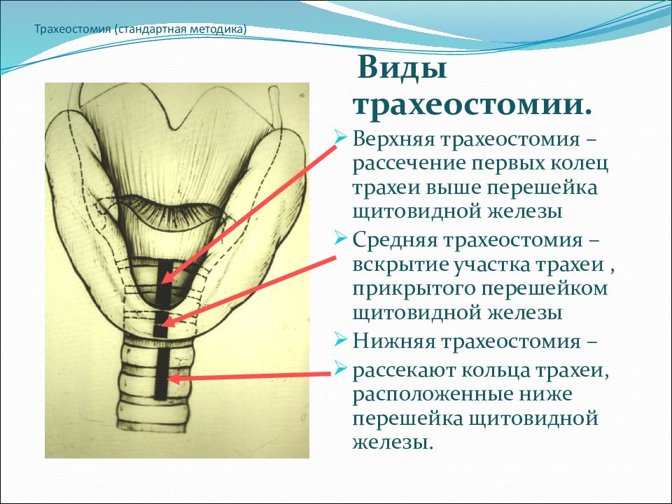 Топографическая анатомия и оперативная хирургия шеи презентация