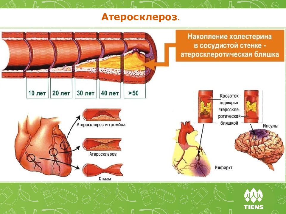 Как лечить атеросклероз. Атеросклеротические изменения сосудов. Атеросклероз коронарных артерий стадии. Атеросклероз холестериновая бляшка схема. Накопление холестерина в сосудистой стенке.