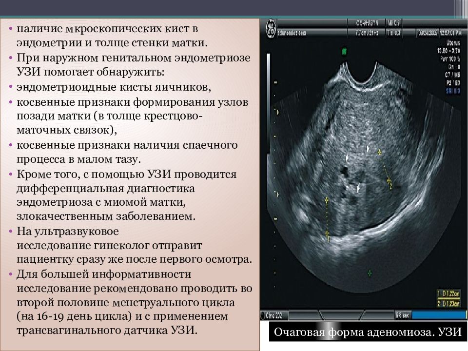 1 фаза эндометрия. Эндометриоз матки УЗИ признаки. Эндометриоз УЗИ признаки. УЗИ признаки эндометриоза матки. Эндометриоз очаговая форма.