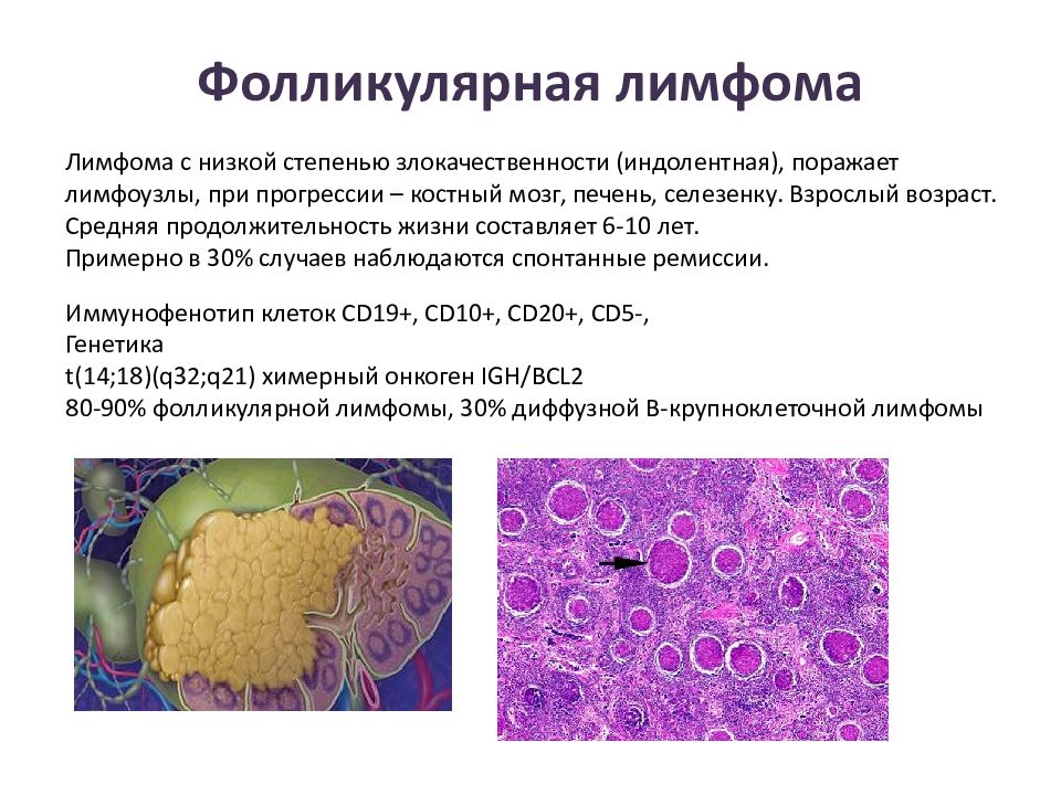 Крупноклеточная лимфома