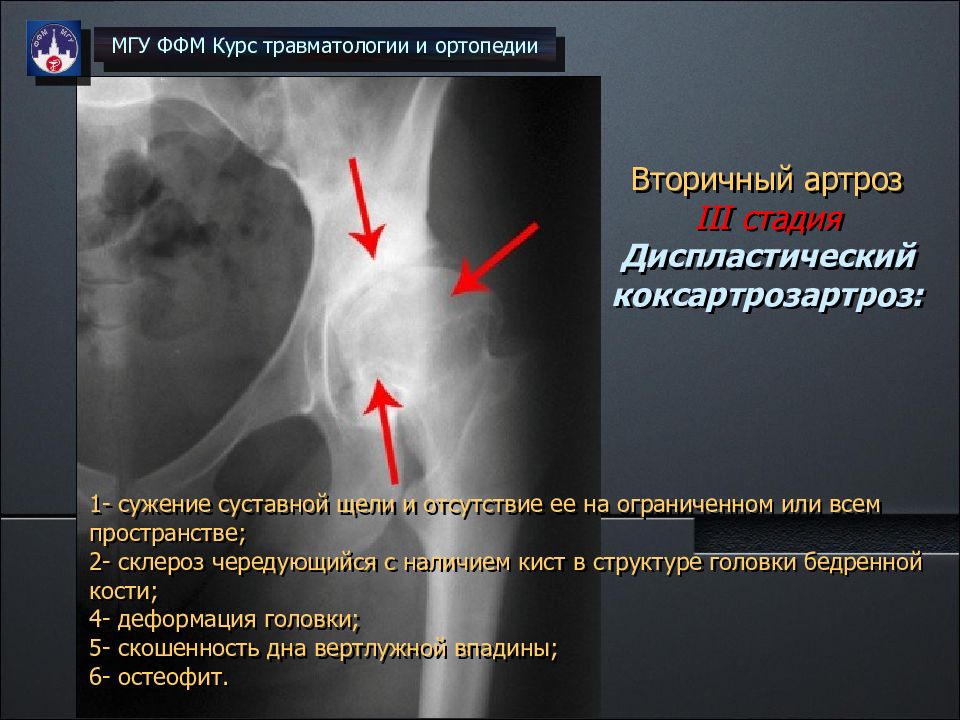 Асептический коксартроз. Асептический некроз вертлужной впадины. Идиопатический асептический некроз кости. Асептический некроз в травматологии.