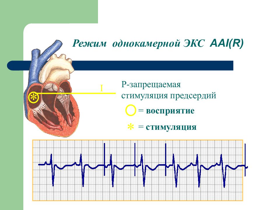 Режимы работы экс. ЭКГ при предсердной стимуляции. Стимуляция предсердий. Предсердная стимуляция режим. Ритм экс предсердная стимуляция.
