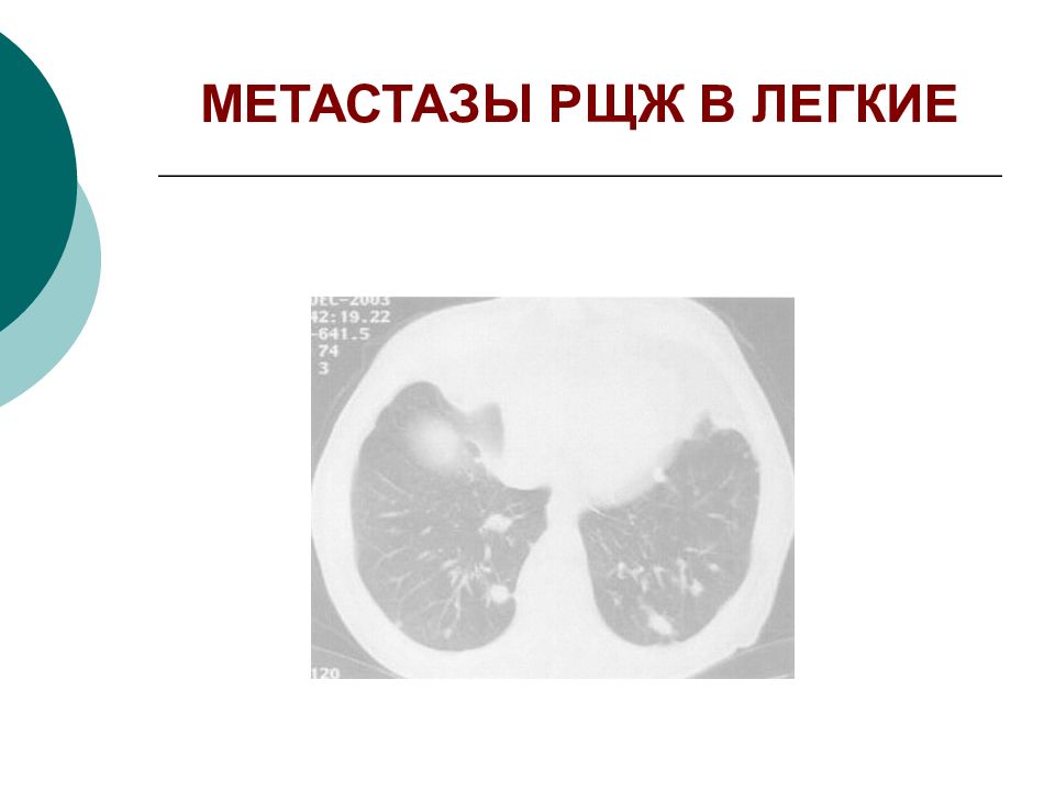 Метастазы при раке щитовидной железы. Метастазы в легких от щитовидки.