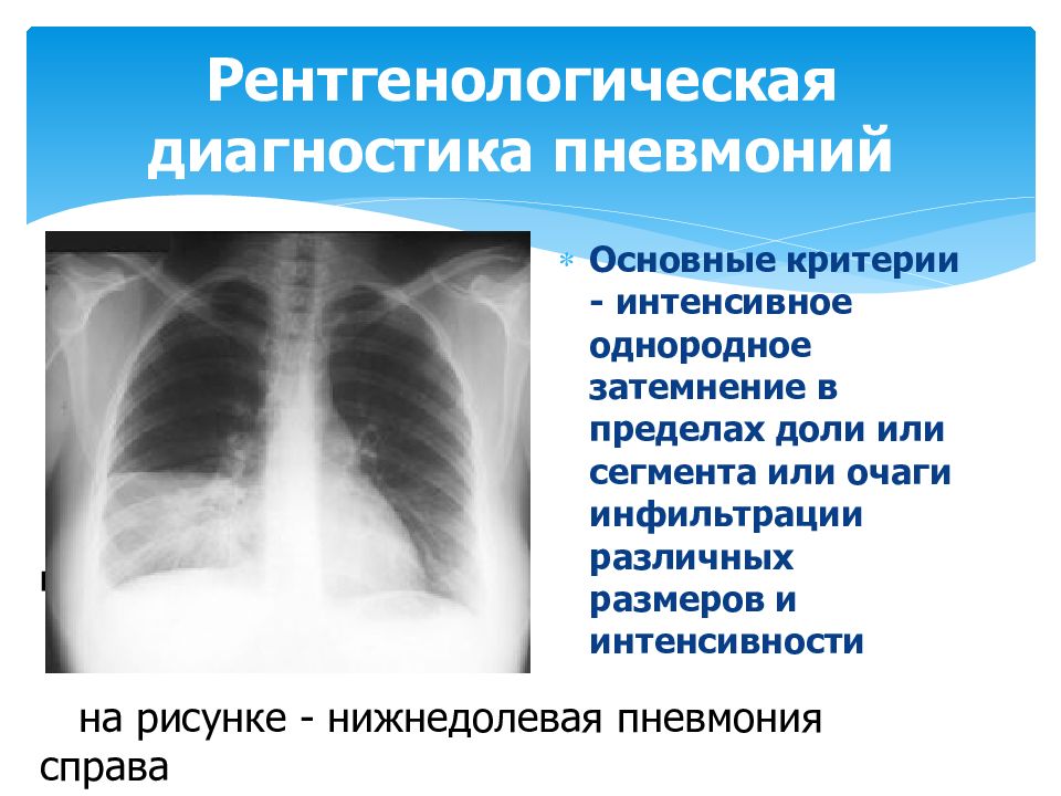 Атипичная пневмония картинки