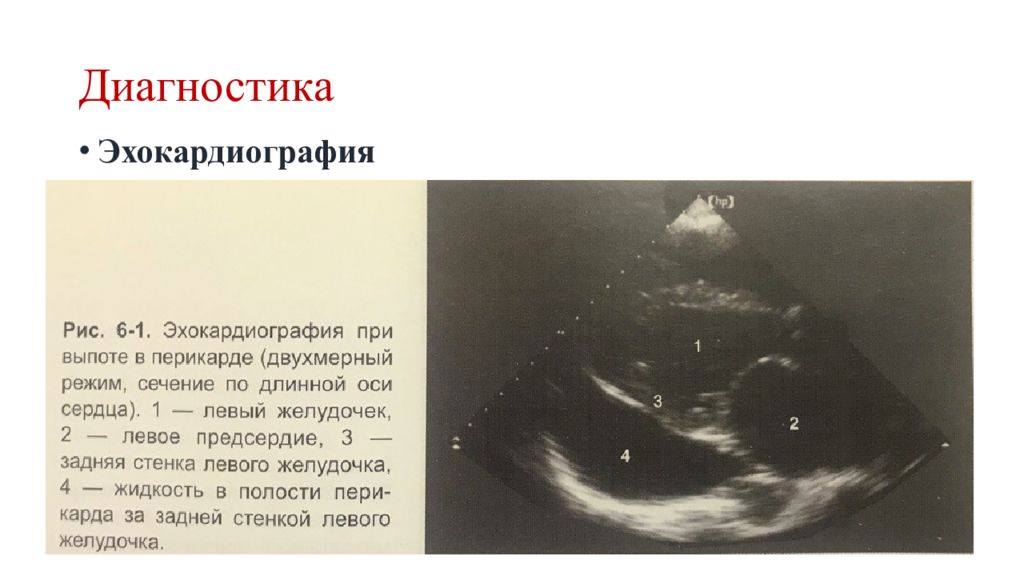 Жидкость в перикарде. ЭХОКГ норма жидкости в перикарде. Жидкость в перикарде на ЭХОКГ. Выпот в полости перикарда. Сепарация листков перикарда на ЭХОКГ.