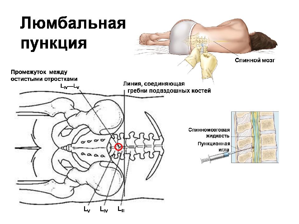 Люмбальная пункция презентация