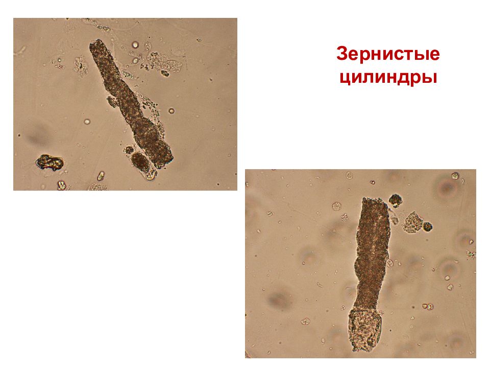 Зернистый цилиндр в моче фото