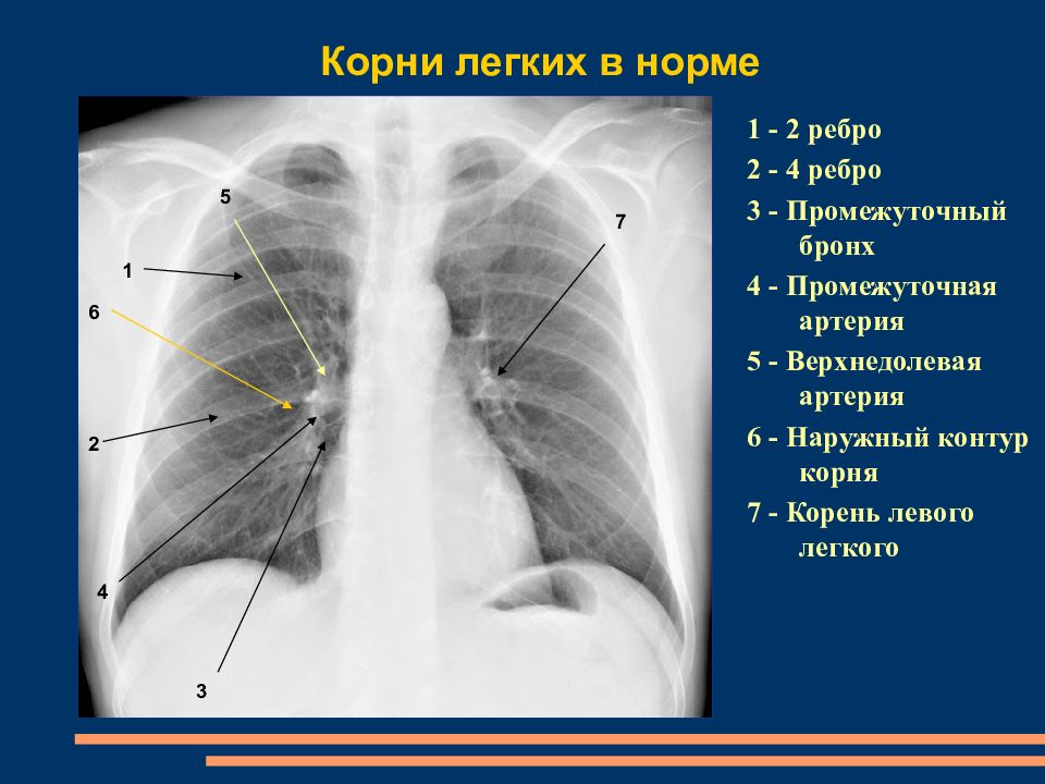 Изменения корня легкого. Корень легкого на рентгенограмме в норме. Корень легкого в норме на рентгене. Корень правого легкого. Корни легких на рентгене.