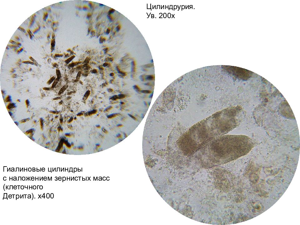 Цилиндры в моче фото под микроскопом