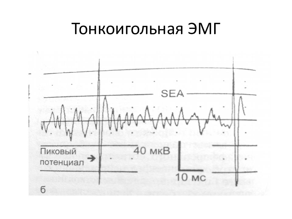 Эмг самара. Электромиография график. Электромиография расшифровка. Электромиография параметры.