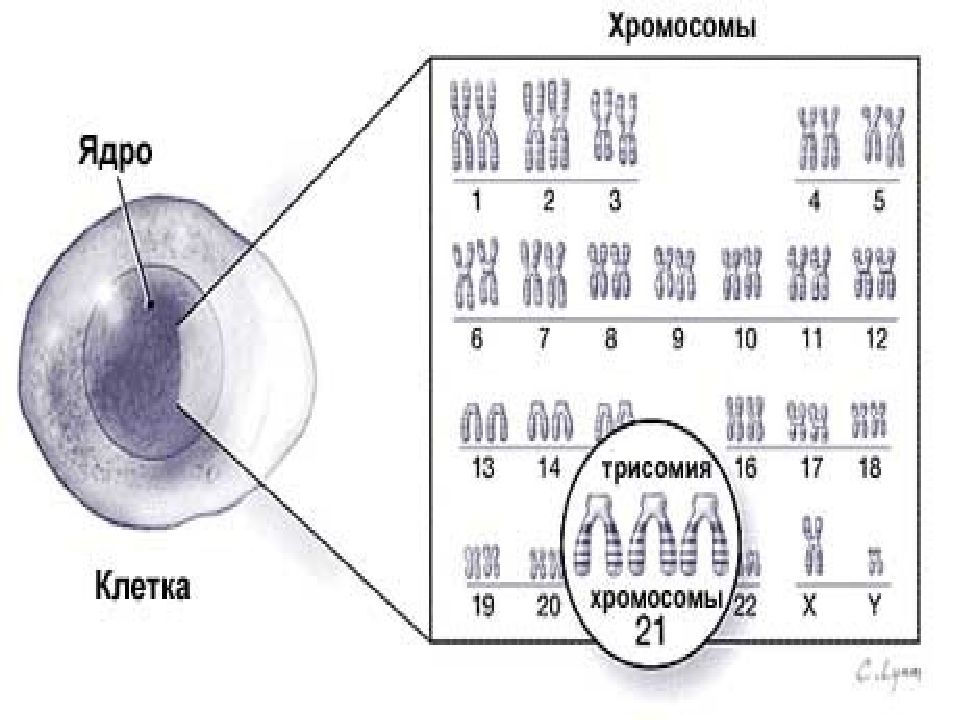 Трисомия это. Мозаичная трисомия 22 хромосомы что это. Трисомия х-хромосомы 22. Трисомия по 22 паре хромосом.