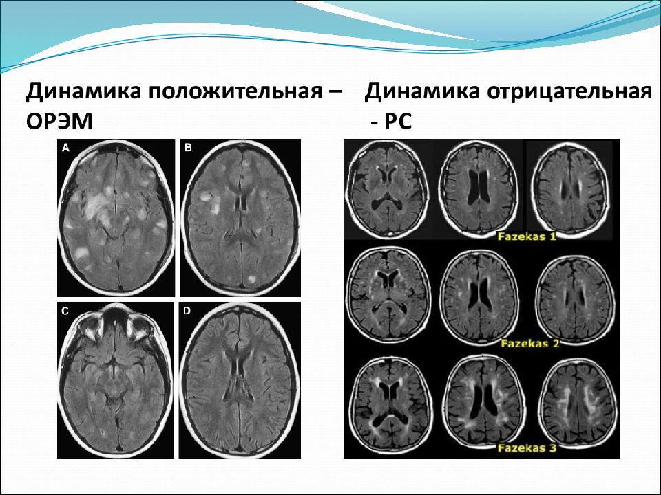 Острый рассеянный энцефаломиелит презентация