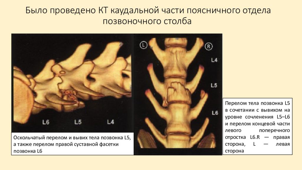 Анатомия поясничного отдела позвоночника презентация