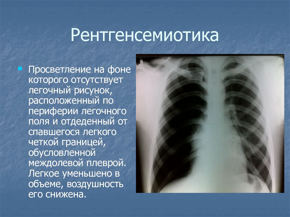 Просветление в легких. Междолевой плеврит рентген. Просветление легочного поля. Просветление на рентгенограмме. Обширное просветление легочного поля.