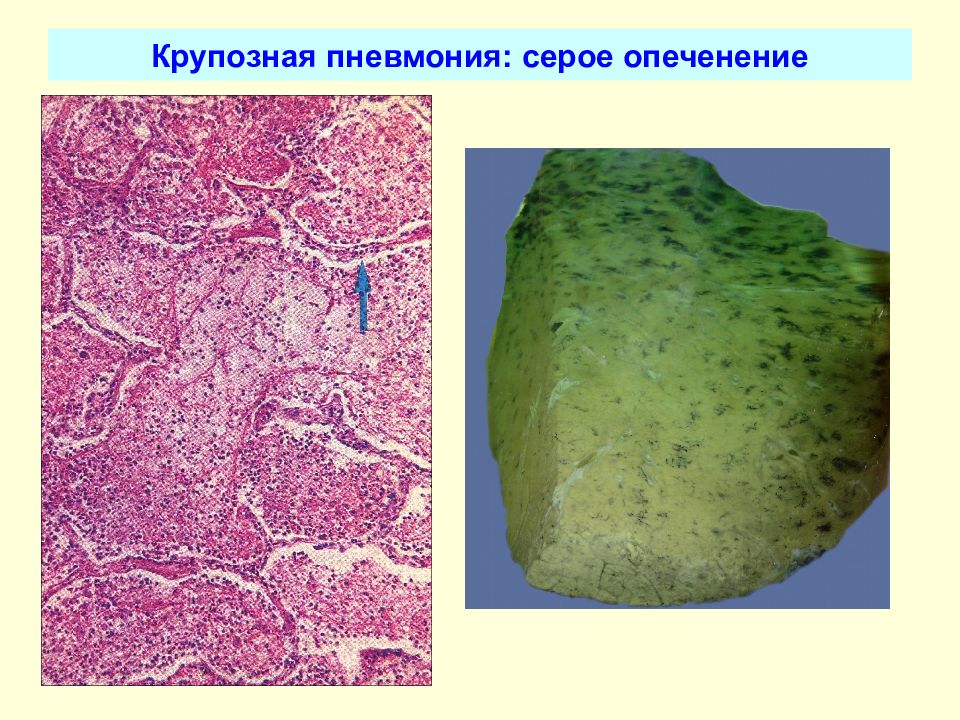 Крупозная пневмония. Крупозная пневмония макропрепарат серого опеченения. Пневмония макропрепарат серое опеченение. Пневмония стадия серого опеченения. Стадия красного опеченения при крупозной пневмонии микропрепарат.