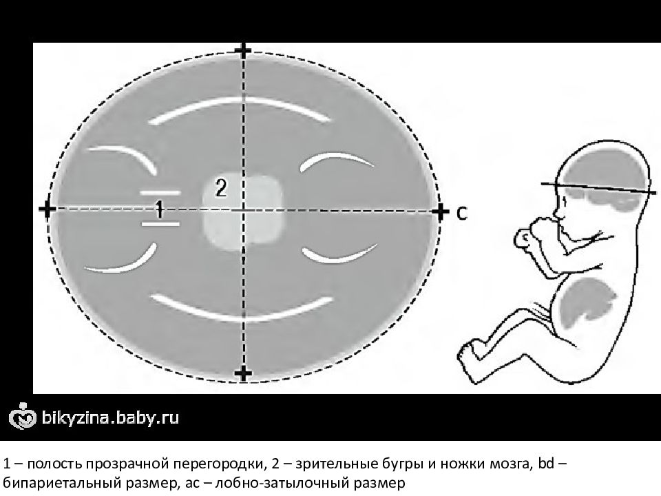Что такое бпр при узи. Бипариетальный диаметр. Лобно-затылочный размер. Бипариетальный размер головы плода. Лобно-затылочный размер головки.