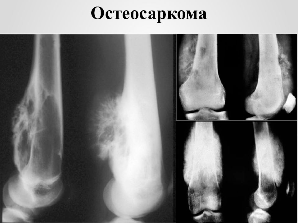Остеосаркома симптомы фото