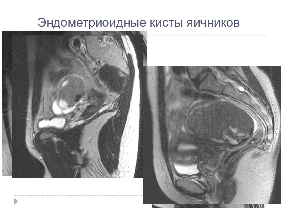 Эндометриоидная киста. Эндометриоидная киста яичника мрт. Эндометриоидные кисты мрт. Эндометриоидные кисты яичников мрт. Дермоидная киста яичника мрт.