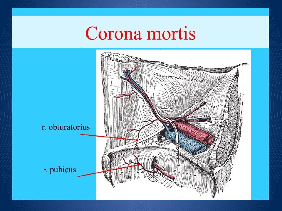 Бедренная грыжа. Корона Мортис анастомоз. Корона смерти топографическая анатомия. Венец смерти топографическая анатомия.