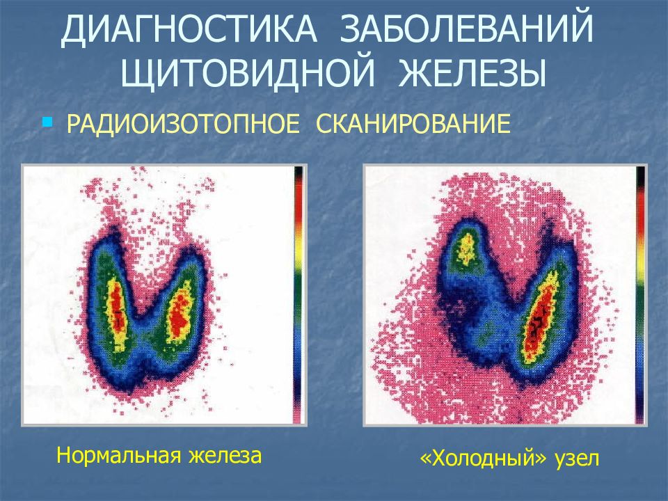 Диагностика щитовидной железы презентация