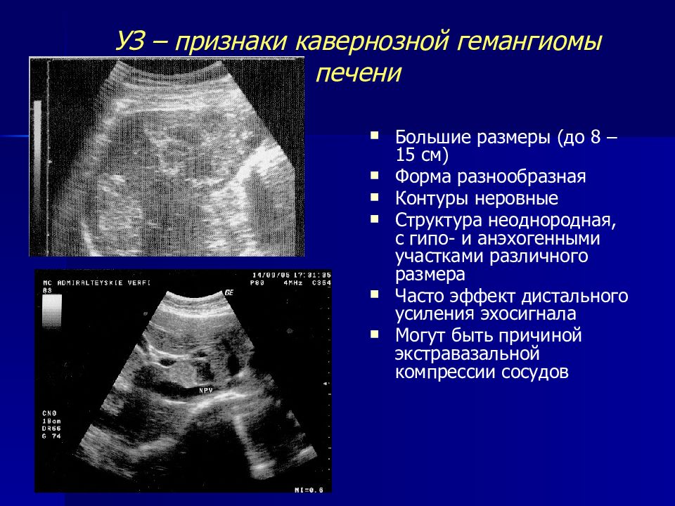 Гемангиомы печени фото на узи