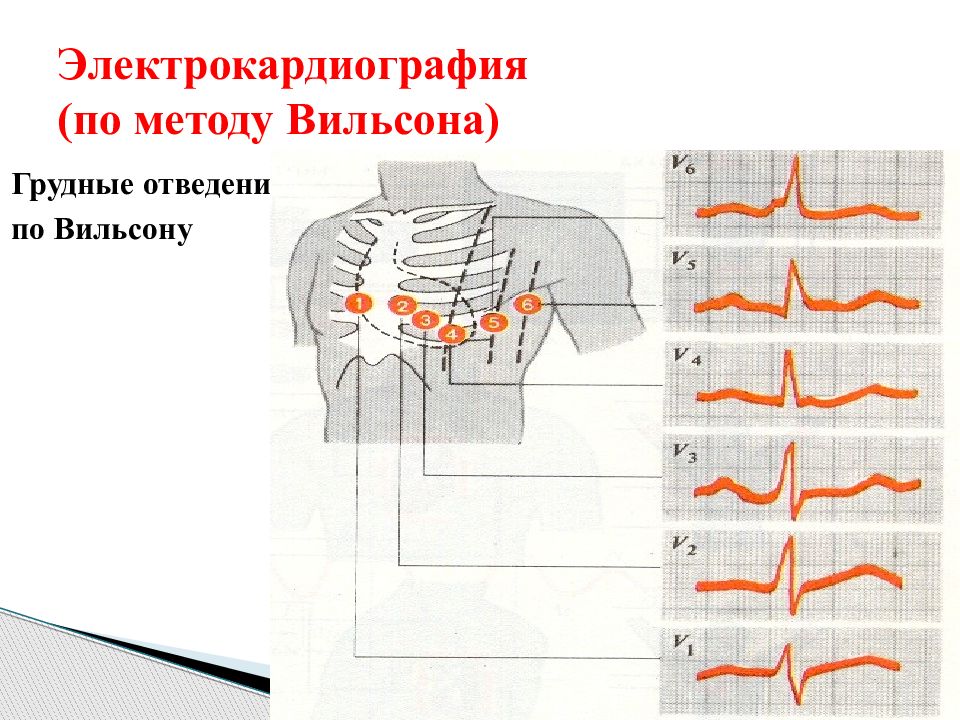 Экг грудные. Грудные отведения ЭКГ Вильсона. Грудные отведения по Вильсону. Регистрация ЭКГ В грудных отведениях. Схема Вильсона ЭКГ.