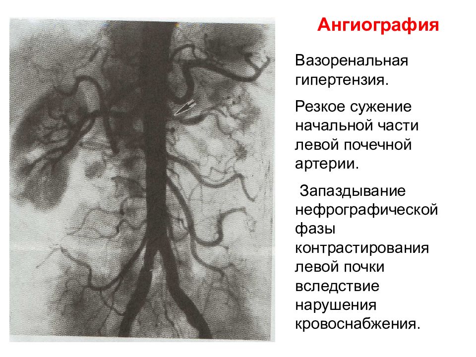 Почечная ангиография презентация