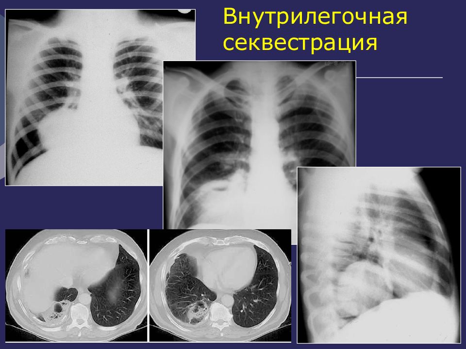 Кисты легких у детей презентация